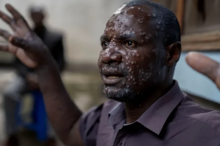Liberia: ‘Avoid sex With Person Suspected of Having Monkeypox symptoms’ NPHIL Warns over Raging Deadly Mpox Strain